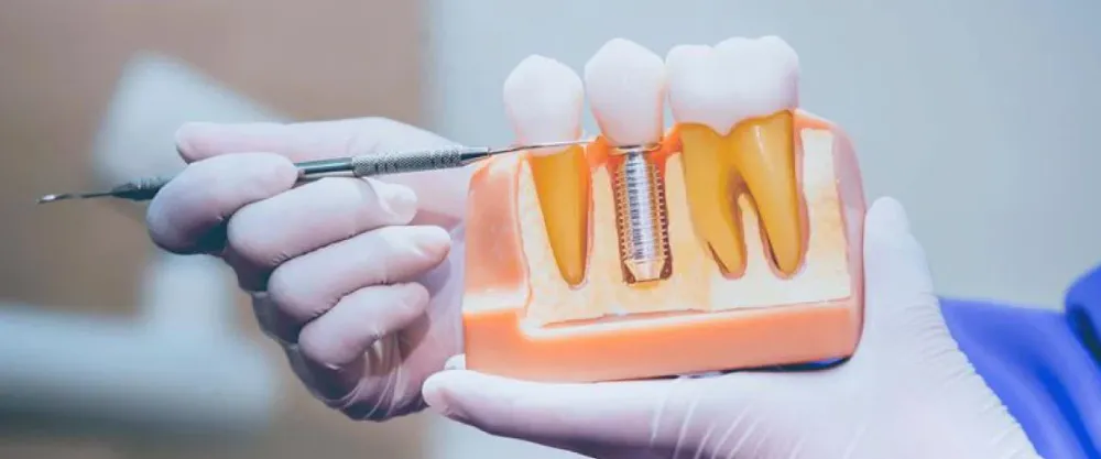 A dental cross-section model showing a titanium implant between two teeth