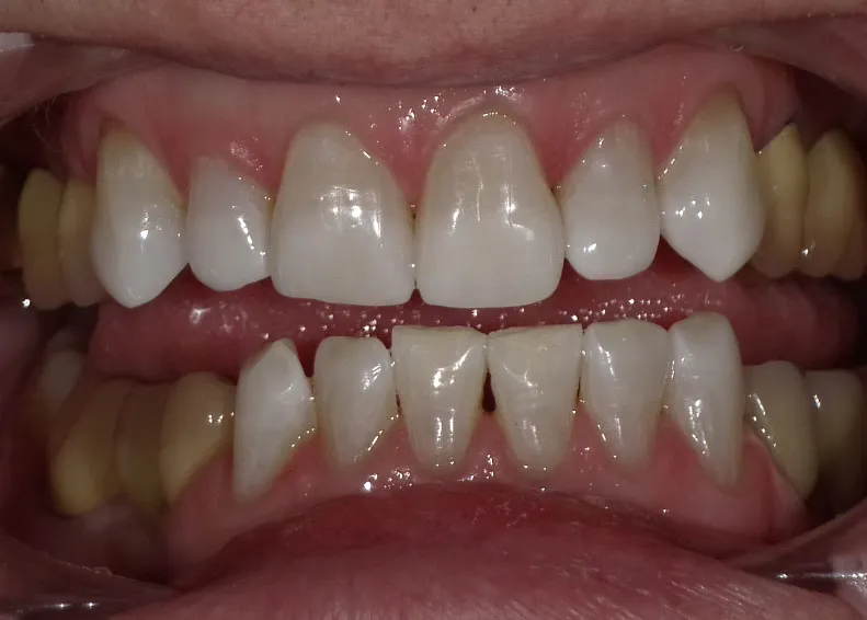 Patient after tetracycline stain bleaching treatment