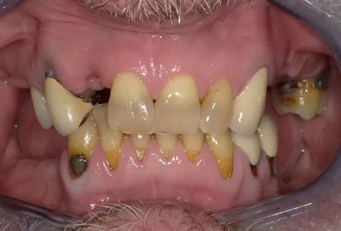 Patient before full mouth rehabilitation treatment