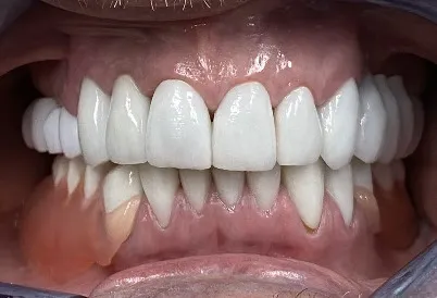 Patient after full mouth rehabilitation treatment