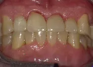 Patient after 4 anterior crowns treatment