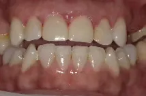 Patient after anterior crown replacement treatment