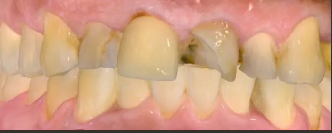Patient before 4 anterior crowns treatment