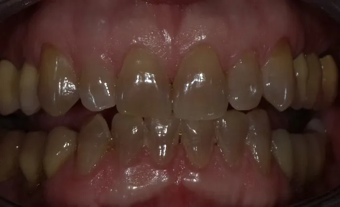 Patient before tetracycline stain bleaching treatment